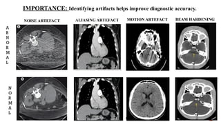 IMPORTANCE: Identifying artifacts helps improve diagnostic accuracy.
MOTION ARTEFACT BEAM HARDENING
NOISE ARTEFACT ALIASING ARTEFACT
A
B
N
O
R
M
A
L
N
O
R
M
A
L
 