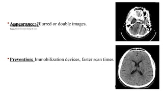 1-MOTION ARTIFACT:
Cause: Patient movement during the scan.
Appearance: Blurred or double images.
Prevention: Immobilization devices, faster scan times.
 
