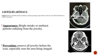 3-JEWELRY ARTIFACT:
Cause:presence of metallic jewelry (necklaces, earrings, piercings, rings) within or near the scan field which block or
scatter x-ray beams
Appearance: Bright streaks or starburst
patterns radiating from the jewelry.
Prevention: remove all jewelry before the
scan, especially near the area being imaged.
 