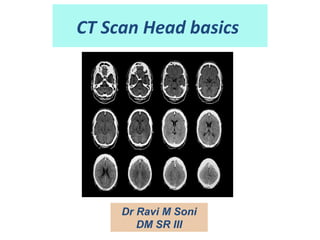 CT Scan Head basics
Dr Ravi M Soni
DM SR III
 
