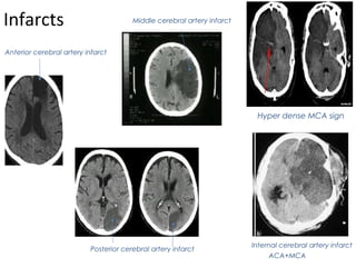 CT Scan Head basics | PPT