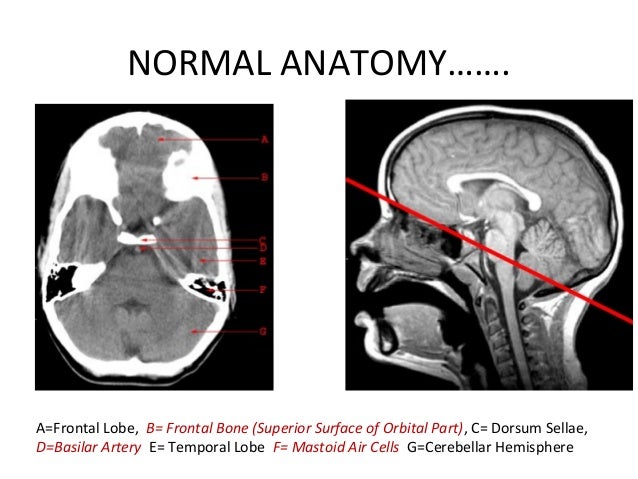 CT Scan Head basics