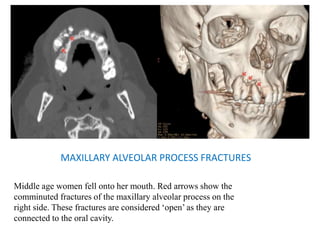 MAXILLARY ALVEOLAR PROCESS FRACTURES
Middle age women fell onto her mouth. Red arrows show the
comminuted fractures of the maxillary alveolar process on the
right side. These fractures are considered ‘open’ as they are
connected to the oral cavity.
 