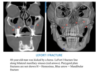 LEFORT I FRACTURE
48-year-old man was kicked by a horse. LeFort I fracture line
along bilateral maxillary sinuses (red arrows). Pterygoid plate
fractures are not shown H = Hemosinus, Blue arrow = Mandibular
fracture
 