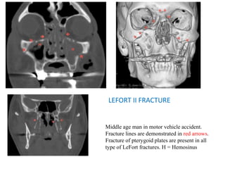 LEFORT II FRACTURE
Middle age man in motor vehicle accident.
Fracture lines are demonstrated in red arrows.
Fracture of pterygoid plates are present in all
type of LeFort fractures. H = Hemosinus
 