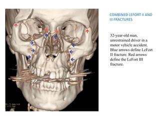 COMBINED LEFORT II AND
III FRACTURES
32-year-old man,
unrestrained driver in a
motor vehicle accident.
Blue arrows define LeFort
II fracture. Red arrows
define the LeFort III
fracture.
 