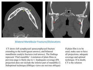 Bilateral Mandibular Fractures/Dislocations
CT shows left symphyseal/ parasymphyseal fracture
extending to the tooth (green arrows), and bilateral
mandibular condyle fractures (red arrows). The findings
represent ‘Flail mandible’. Limitation of plain films in
previous page is likely due to 1. Inadequate coverage (PA
projection does not include the inferior part of mandible) 2.
Suboptimal technique (Oblique views are not true oblique)
If plain film is to be
used, make sure to have
all projections, adequate
coverage and optimal
technique. If in doubt,
CT is the solution
 