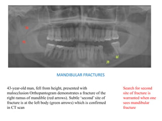 MANDIBULAR FRACTURES
43-year-old man, fell from height, presented with
malocclusion Orthopantogram demonstrates a fracture of the
right ramus of mandible (red arrows). Subtle ‘second’ site of
fracture is at the left body (green arrows) which is confirmed
in CT scan
Search for second
site of fracture is
warranted when one
sees mandibular
fracture
 