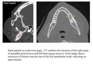 Same patient as in previous page. CT confirms the fractures of the right angle
of mandible (red arrows) and left body (green arrows). Axial image shows
extension of fracture into the root of the left mandibular tooth, indicating an
open fracture
 