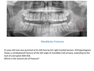 Mandibular Fractures
21-year-old man was punched at his left face by the right-handed person. Orthopantogram
shows a nondisplaced fracture of the left angle of mandible (red arrows), extending to the
root of unerupted ADA #18.
Where is the second site of fracture?
 