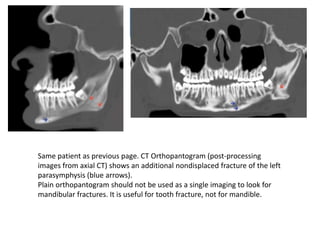 Same patient as previous page. CT Orthopantogram (post-processing
images from axial CT) shows an additional nondisplaced fracture of the left
parasymphysis (blue arrows).
Plain orthopantogram should not be used as a single imaging to look for
mandibular fractures. It is useful for tooth fracture, not for mandible.
 