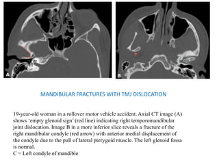 MANDIBULAR FRACTURES WITH TMJ DISLOCATION
19-year-old woman in a rollover motor vehicle accident. Axial CT image (A)
shows ‘empty glenoid sign’ (red line) indicating right temporomandibular
joint dislocation. Image B in a more inferior slice reveals a fracture of the
right mandibular condyle (red arrow) with anterior medial displacement of
the condyle due to the pull of lateral pterygoid muscle. The left glenoid fossa
is normal.
C = Left condyle of mandible
 