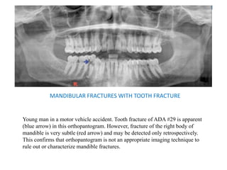 MANDIBULAR FRACTURES WITH TOOTH FRACTURE
Young man in a motor vehicle accident. Tooth fracture of ADA #29 is apparent
(blue arrow) in this orthopantogram. However, fracture of the right body of
mandible is very subtle (red arrow) and may be detected only retrospectively.
This confirms that orthopantogram is not an appropriate imaging technique to
rule out or characterize mandible fractures.
 