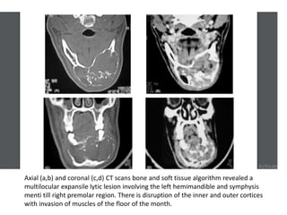 Axial (a,b) and coronal (c,d) CT scans bone and soft tissue algorithm revealed a
multilocular expansile lytic lesion involving the left hemimandible and symphysis
menti till right premolar region. There is disruption of the inner and outer cortices
with invasion of muscles of the floor of the month.
 