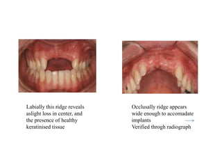 Labially this ridge reveals
aslight loss in center, and
the presence of healthy
keratinised tissue
Occlusally ridge appears
wide enough to accomadate
implants
Verified throgh radiograph
 