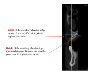 Width of the maxillary alveolar ridge
measured at a specific point prior to
implant placement
Height of the maxillary alveolar ridge
measured at a specific point at a specific
point prior to implant placement
 