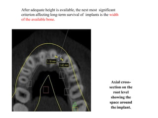 After adequate height is available, the next most significant
criterion affecting long-term survival of implants is the width
of the available bone.
Axial cross-
section on the
root level
showing the
space around
the implant.
 