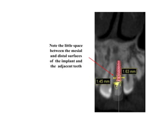 Note the little space
between the mesial
and distal surfaces
of the implant and
the adjacent teeth
 