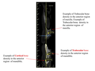Example of Trabecular bone
density in the anterior region
of maxilla. Example of
Trabecular bone density in
the anterior region of
maxilla.
Example of Trabecular bone
density in the anterior region
of mandible.Example of Cortical bone
density in the anterior
region of mandible.
 