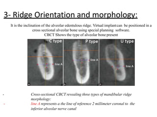 3- Ridge Orientation and morphology:
It is the inclination of the alveolar edentulous ridge. Virtual implantcan be positioned in a
cross sectional alveolar bone using special planning software.
CBCT Shows the type of alveolar bone present
- Cross-sectional CBCT revealing three types of mandibular ridge
morphology:
- line A represents a the line of reference 2 millimeter coronal to the
inferior alveolar nerve canal
 