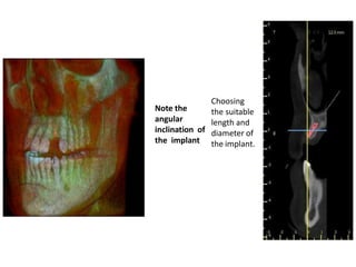 Note the
angular
inclination of
the implant
Choosing
the suitable
length and
diameter of
the implant.
 