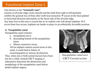 Functional Implant Zone 1
Also known as the “traumatic zone”
consists of alveolar ridge of pre-maxilla and the teeth from right to left premolar
exhibits the greatest loss of bone after tooth loss/extraction  occurs in the facio-palatal
or horizontal direction and mainly on the facial side of the alveolar ridge
Any bone loss in this area is crucial due to its esthetic risk with dental implants  if
severe bone loss occurs, implants are harder to place in an esthetically favorable position.
1) Nasopalatine canal
Nasopalatine canal contains:
a. nasopalatine nerve
b. descending branch of the nasopalatine
artery
c. fibrous connective tissue
if an implant contacts neural tissue in this
canal, it could lead to failure of
osseointegration or sensory dysfunction.
Thus, when one or both central incisors have been
lost for a while, limited CBCT imaging is
indicated to determine the dimensions and
morphology of the nasopalatine canal before
dental implant surgery.
Nasopalatine canal on a
CBCT Coronal section
 