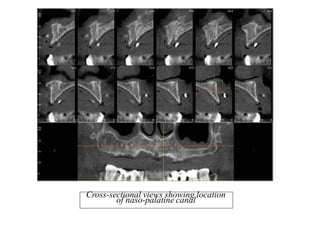 Cross-sectional views showing location
of naso-palatine canal
 