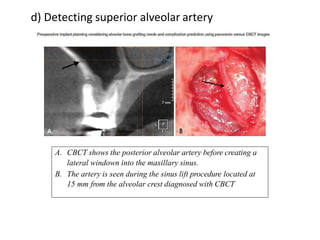 d) Detecting superior alveolar artery
A. CBCT shows the posterior alveolar artery before creating a
lateral windown into the maxillary sinus.
B. The artery is seen during the sinus lift procedure located at
15 mm from the alveolar crest diagnosed with CBCT
 