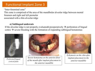 “Inter-foraminal zone”
This zone is comprised of the area of the mandibular alveolar ridge between mental
foramen and right and left premolar
associated with a thin alveolar ridge
a) Sublingual undercuts
If the alveolar ridge is not properly evaluatedd preoperatively  perforation of lingual
cortex  severe bleeding with the formation of expanding sublingual hematomas
Perforatedlingual
cortical plate
Severe hematoma on the anterior floor
of the mouth after implant placement in
the anterior mandible
Echymosis on the chin after
implant placement in the
anterior mandible
Functional Implant Zone 3
 