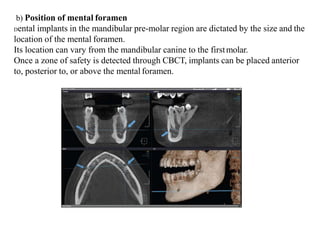 b) Position of mental foramen
Dental implants in the mandibular pre-molar region are dictated by the size and the
location of the mental foramen.
Its location can vary from the mandibular canine to the firstmolar.
Once a zone of safety is detected through CBCT, implants can be placed anterior
to, posterior to, or above the mental foramen.
 