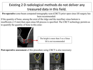 Existing 2 D radiological methods do not deliver any
treasured data in this field.
Pre-operative cone-beam computed tomography scan (CBCT) prior open sinus lift surgery has
been recommended:
If the quantity of bone, among the crest of the ridge and the maxillary sinus bottom is
insufficient, (<5 mm) then open sinus lift process is specified. The CBCT technology permits us
to quantify the quantity of bone in this zone:
Post-operative assessment of this procedure using CBCT is also necessary:
The height is more than 5 so a Sinus
lift is not recommended
 