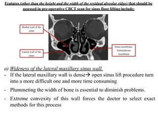 Features (other than the height and the width of the residual alveolar ridge) that should be
assessed in pre-operative CBCT scan for sinus floor lifting include:
Medial wall of the
sinus
Lateral wall of the
sinus
Sinus membrane:
Schneiderian
membrane
a) Wideness of the lateral maxillary sinus wall.
- If the lateral maxillary wall is dense open sinus lift procedure turn
into a more difficult one and more time consuming
- Plummeting the width of bone is essential to diminish problems.
- Extreme convexity of this wall forces the doctor to select exact
methods for this process
 