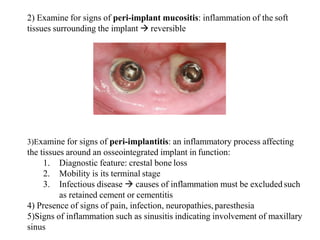 2) Examine for signs of peri-implant mucositis: inflammation of the soft
tissues surrounding the implant  reversible
3)Examine for signs of peri-implantitis: an inflammatory process affecting
the tissues around an osseointegrated implant in function:
1. Diagnostic feature: crestal bone loss
2. Mobility is its terminal stage
3. Infectious disease  causes of inflammation must be excluded such
as retained cement or cementitis
4) Presence of signs of pain, infection, neuropathies, paresthesia
5)Signs of inflammation such as sinusitis indicating involvement of maxillary
sinus
 