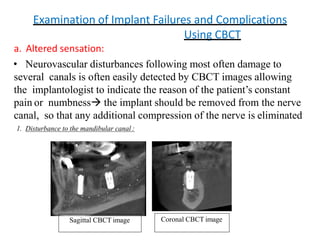 Examination of Implant Failures and Complications
Using CBCT
a. Altered sensation:
• Neurovascular disturbances following most often damage to
several canals is often easily detected by CBCT images allowing
the implantologist to indicate the reason of the patient’s constant
pain or numbness the implant should be removed from the nerve
canal, so that any additional compression of the nerve is eliminated
1. Disturbance to the mandibular canal :
Sagittal CBCT image Coronal CBCT image
 
