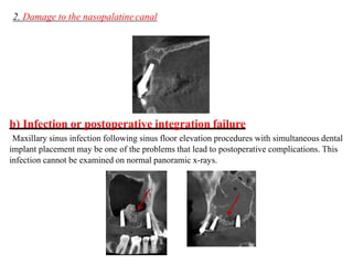 2. Damage to the nasopalatine canal
b) Infection or postoperative integration failure
Maxillary sinus infection following sinus floor elevation procedures with simultaneous dental
implant placement may be one of the problems that lead to postoperative complications. This
infection cannot be examined on normal panoramic x-rays.
 