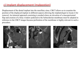 c) Implant displacement (malpostion)
Displacement of the dental implant into the maxillary sinus. CBCT allows us to examine the
position of the displaced implant in different aspects allowing the implantologist to locate it for
removal. An intraoral approach consisting is needed where an elevation of a mucoperiosteal
flap and creation of a bony window pedicled to the Schneiderian membrane must be adopted in
reference to the CBCT images because perforation of the membrane is highly relevant in such a
procedure.
 