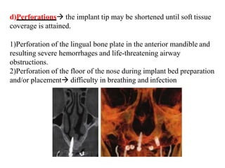 d)Perforations the implant tip may be shortened until soft tissue
coverage is attained.
1)Perforation of the lingual bone plate in the anterior mandible and
resulting severe hemorrhages and life-threatening airway
obstructions.
2)Perforation of the floor of the nose during implant bed preparation
and/or placement difficulty in breathing and infection
 
