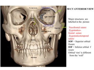 3D CT ANTERIOR VIEW
Major structures are
labelled in the picture
Nasofrontal suture
Zygomatico-
frontal suture
Zygomaticotemporal
suture
SOF = Superior orbital
fissure
IOF = Inferior orbital f
issure
Orbital ‘rim’ is different
from the ‘wall’
 