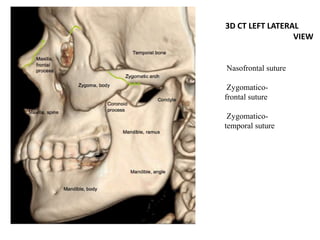 3D CT LEFT LATERAL
VIEW
Nasofrontal suture
Zygomatico-
frontal suture
Zygomatico-
temporal suture
 