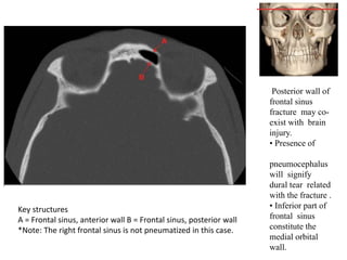 Posterior wall of
frontal sinus
fracture may co-
exist with brain
injury.
• Presence of
pneumocephalus
will signify
dural tear related
with the fracture .
• Inferior part of
frontal sinus
constitute the
medial orbital
wall.
Key structures
A = Frontal sinus, anterior wall B = Frontal sinus, posterior wall
*Note: The right frontal sinus is not pneumatized in this case.
 