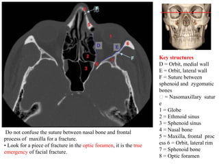 Key structures
D = Orbit, medial wall
E = Orbit, lateral wall
F = Suture between
sphenoid and zygomatic
bones
= Nasomaxillary sutur
e
1 = Globe
2 = Ethmoid sinus
3 = Sphenoid sinus
4 = Nasal bone
5 = Maxilla, frontal proc
ess 6 = Orbit, lateral rim
7 = Sphenoid bone
8 = Optic foramen
Do not confuse the suture between nasal bone and frontal
process of maxilla for a fracture.
• Look for a piece of fracture in the optic foramen, it is the true
emergency of facial fracture.
 