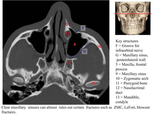 Key structures
F = Groove for
infraorbital nerve
G = Maxillary sinus,
posterolateral wall
5 = Maxilla, frontal
process
9 = Maxillary sinus
10 = Zygomatic arch
11 = Pterygoid bone
12 = Nasolacrimal
duct
13 = Mandible,
condyle
Clear maxillary sinuses can almost rules out certain fractures such as ZMC, LeFort, blowout
fractures.
 
