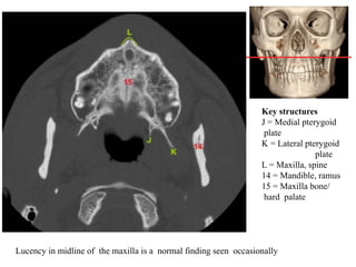 Key structures
J = Medial pterygoid
plate
K = Lateral pterygoid
plate
L = Maxilla, spine
14 = Mandible, ramus
15 = Maxilla bone/
hard palate
Lucency in midline of the maxilla is a normal finding seen occasionally
 
