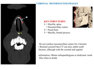 CORONAL REFORMATTED IMAGES
KEY STRUCTURES
L = Maxilla, spine
= Nasomaxillary suture
4 = Nasal bone
5 = Maxilla, frontal process
Do not confuse nasomaxillary suture for a fracture
• Remind yourself that CT can miss subtle tooth
fracture, although with the coronal and sagittal
reformation. Obtain orthopanthogram or dedicated tooth
film when in doubt
 