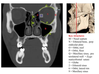 Key structures
M = Nasal septum
N = Ethmoid bone, perp
endicular plate
O = Orbit, roof
P = Orbit, floor
Q = Maxillary sinus, pos
terolateral wall = Zygo
maticofrontal suture
1 = Globe
2 = Ethmoid sinus
6 = Orbit, lateral rim
9 = Maxillary sinus
 