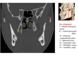 Key structures
J = Medial pterygoid
pslate
K = Lateral pterygoid
plate
N = Ethmoid,
perpendicular plate
3 = Sphenoid sinus
10 = Zygomatic arch
14 = Mandible, ramus
18 = mandible, angle
 