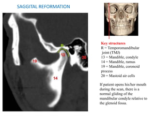 Key structures
R = Temporomandibular
joint (TMJ)
13 = Mandible, condyle
14 = Mandible, ramus
19 = Mandible, coronoid
process
20 = Mastoid air cells
If patient opens his/her mouth
during the scan, there is a
normal gliding of the
mandibular condyle relative to
the glenoid fossa.
SAGGITAL REFORMATION
 