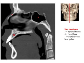 Key structures
3 = Sphenoid sinus
4 = Nasal bone
15= Maxilla bone/
hard palate
 