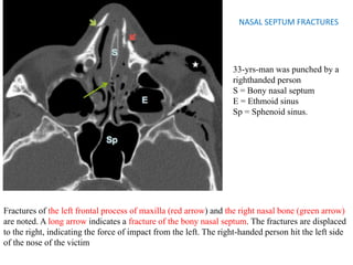 NASAL SEPTUM FRACTURES
33-yrs-man was punched by a
righthanded person
S = Bony nasal septum
E = Ethmoid sinus
Sp = Sphenoid sinus.
Fractures of the left frontal process of maxilla (red arrow) and the right nasal bone (green arrow)
are noted. A long arrow indicates a fracture of the bony nasal septum. The fractures are displaced
to the right, indicating the force of impact from the left. The right-handed person hit the left side
of the nose of the victim
 