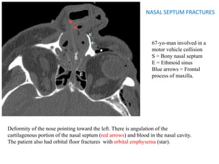 NASAL SEPTUM FRACTURES
67-yo-man involved in a
motor vehicle collision
S = Bony nasal septum
E = Ethmoid sinus
Blue arrows = Frontal
process of maxilla.
Deformity of the nose pointing toward the left. There is angulation of the
cartilagenous portion of the nasal septum (red arrows) and blood in the nasal cavity.
The patient also had orbital floor fractures with orbital emphysema (star).
 